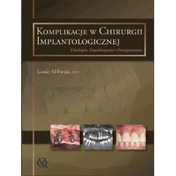 Komplikacje w Chirurgii Implantologicznej - Podręcznik Stomatologia