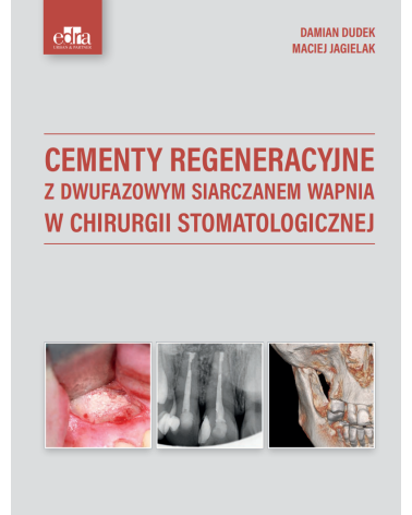 Cementy Regeneracyjne z Dwufazowym Siarczan Wapnia w Chirurgii Stomatologicznej